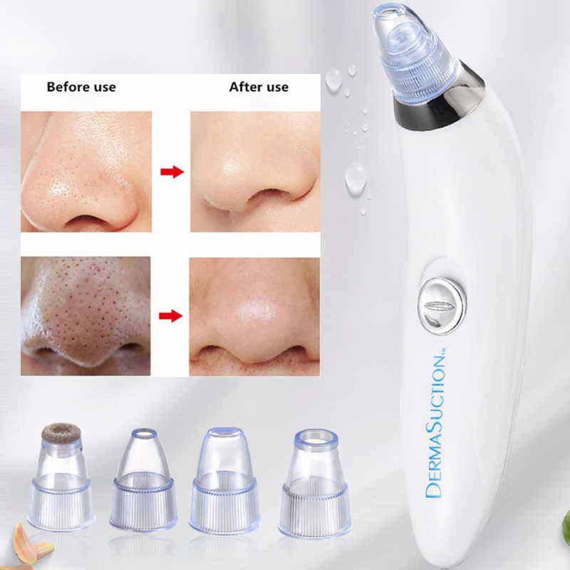 Derma Suction Blackhead Remover & Pore Vacuum